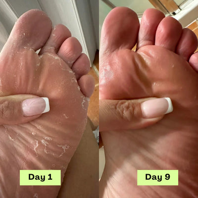 Shaney® AntiFungal Relief Soap Bar