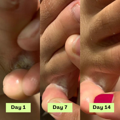 Shaney® AntiFungal Relief Soap Bar