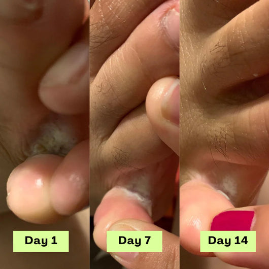 Shaney® AntiFungal Relief Soap Bar